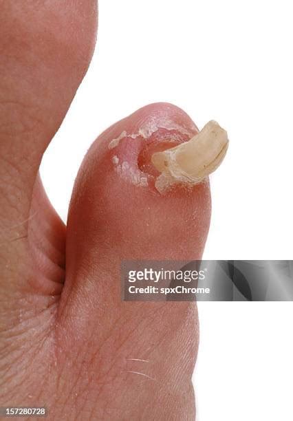 gross feet pictures|6,900+ Gross Feet Stock Photos, Pictures & Royalty